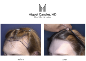 The Life-Changing Benefits of FUE Hair Restoration in California